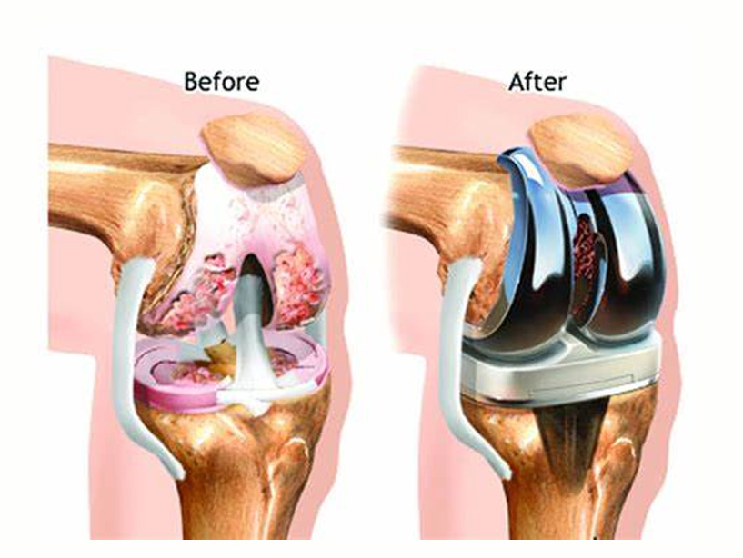 Before after treatment image for knee replacement surgery by Dr. Ketan Vekhande is a renowned Orthopedic & Joint Replacement Surgeon & Specialist in Trauma, Sports Medicine and Arthroscopy in Aurangabad Maharashtra at swastik orthopaedic health care.