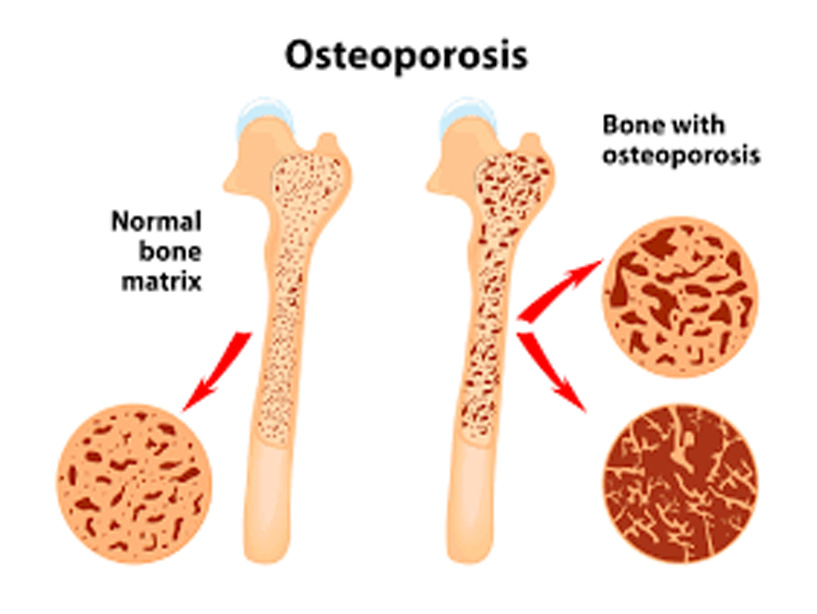 Osteoporosis Treatment by Dr. Ketan Vekhande is a renowned Orthopedic & Joint Replacement Surgeon & Specialist in Trauma, Sports Medicine and Arthroscopy in Aurangabad Maharashtra.