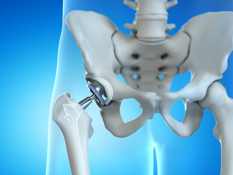 Total Hip Replacement Treatment by Dr. Ketan Vekhande is a renowned Orthopedic & Joint Replacement Surgeon & Specialist in Trauma, Sports Medicine and Arthroscopy in Aurangabad Maharashtra.